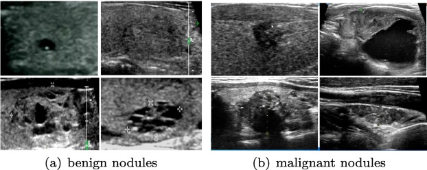 A pre-trained convolutional neural network based method for thyroid nodule diagnosis