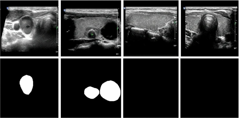 Ultrasound image-based thyroid nodule automatic segmentation using convolutional neural networks