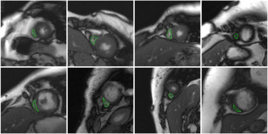 Res-DUnet: A small-region attentioned model for cardiac MRI-based right ventricular segmentation