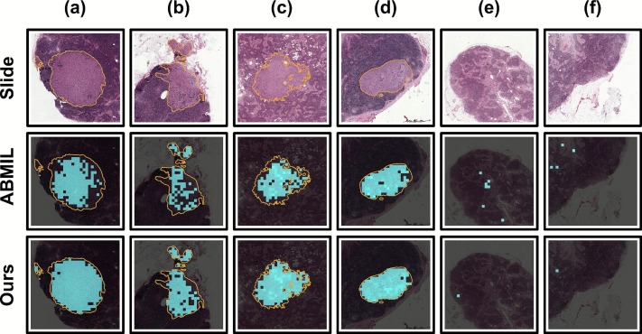 AGDR-MIL: Attention-graded and de-redundant multiple instance learning for whole-slide image classification