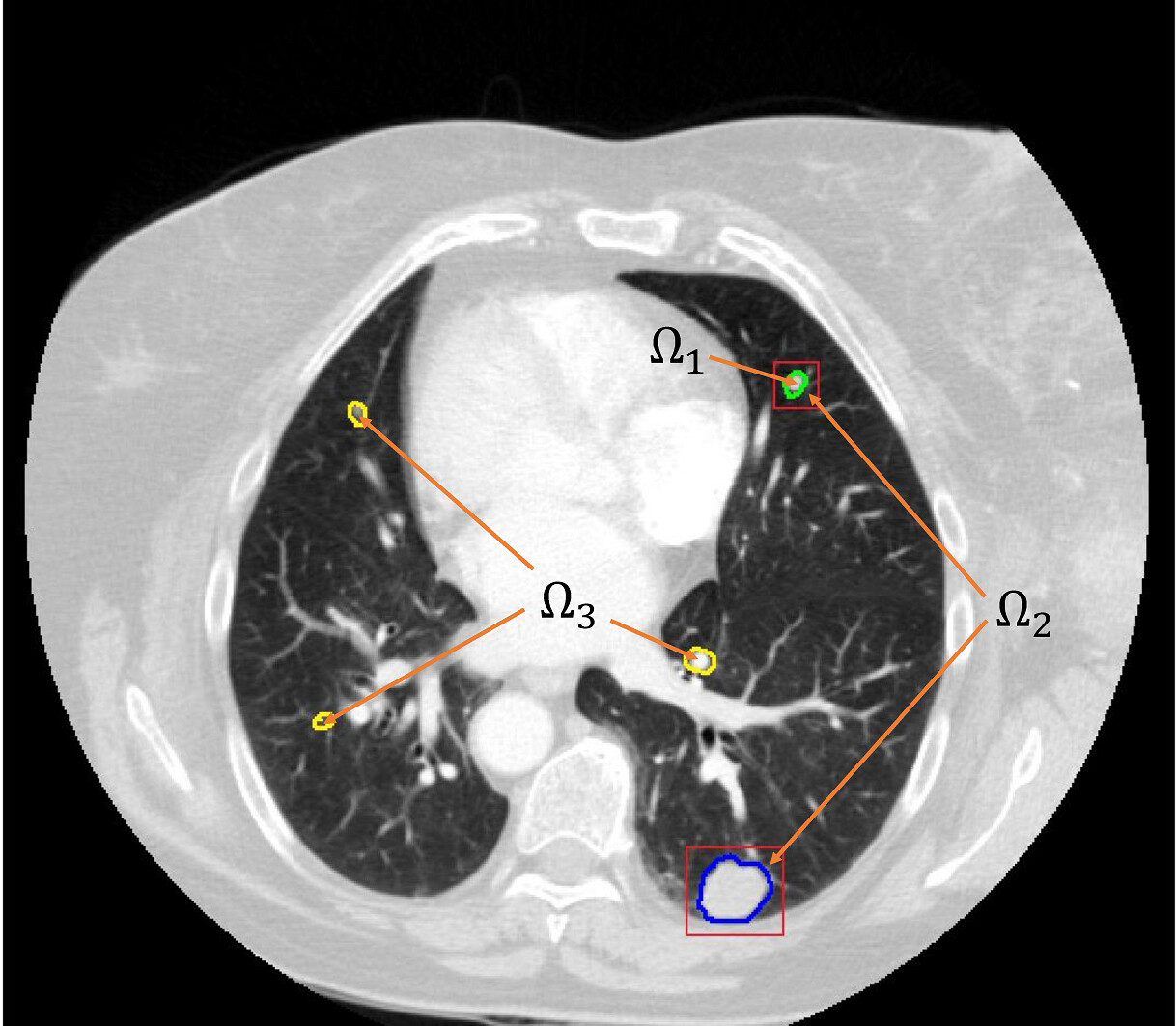 Pulmonary nodule detection using hybrid two-stage 3D CNNs