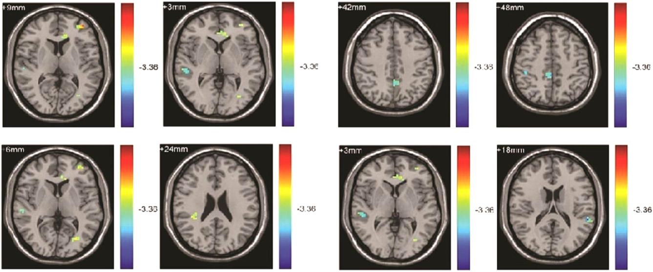 The effect of short cardio on inhibitory control ability of obese people