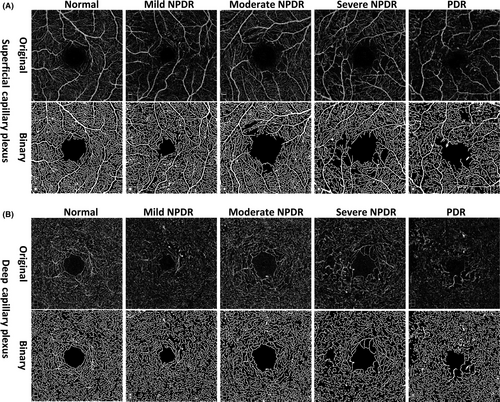 Multifractal and lacunarity analyses of microvascular morphology in eyes with diabetic retinopathy: a projection artifact resolved optical coherence tomography angiography study